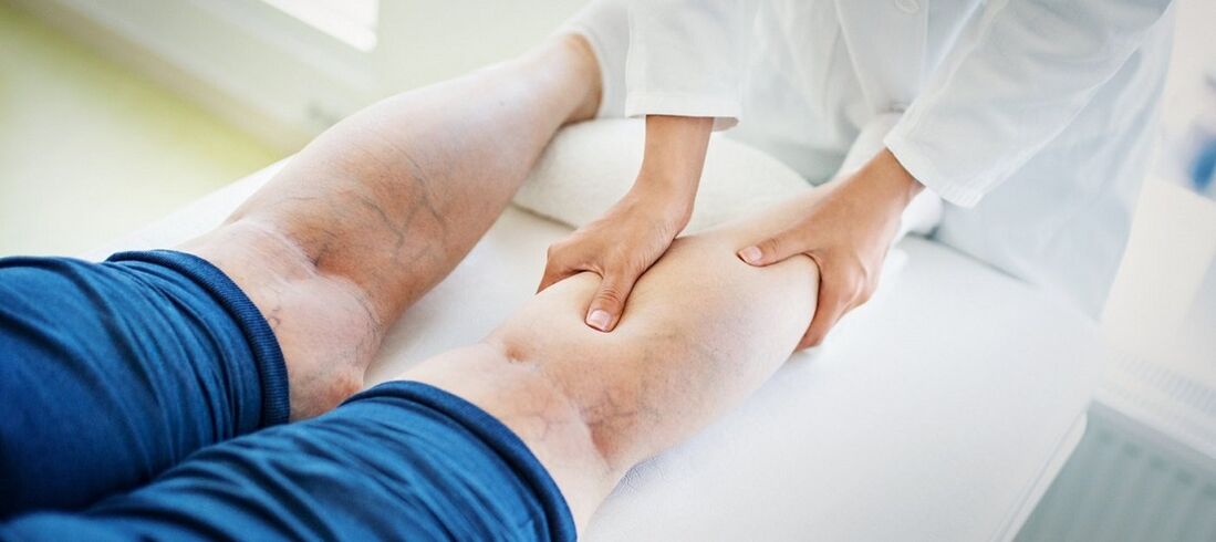 spataderen op de benen en de behandeling ervan